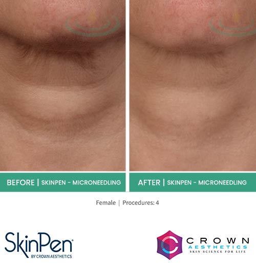 Before & After at Aspire Medical Aesthetics in Scarsdale & New York, NY Before & After at Aspire Medical Aesthetics in Scarsdale & New York, NY