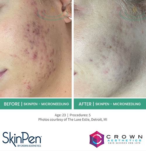 Before & After at Aspire Medical Aesthetics in Scarsdale & New York, NY Before & After at Aspire Medical Aesthetics in Scarsdale & New York, NY