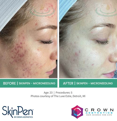 Before & After at Aspire Medical Aesthetics in Scarsdale & New York, NY Before & After at Aspire Medical Aesthetics in Scarsdale & New York, NY