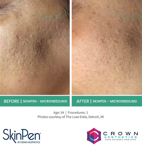 Before & After at Aspire Medical Aesthetics in Scarsdale & New York, NY Before & After at Aspire Medical Aesthetics in Scarsdale & New York, NY