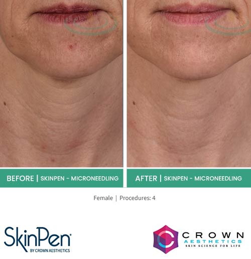 Before & After at Aspire Medical Aesthetics in Scarsdale & New York, NY Before & After at Aspire Medical Aesthetics in Scarsdale & New York, NY