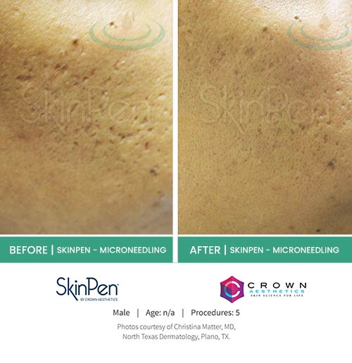 Before & After at Aspire Medical Aesthetics in Scarsdale & New York, NY Before & After at Aspire Medical Aesthetics in Scarsdale & New York, NY