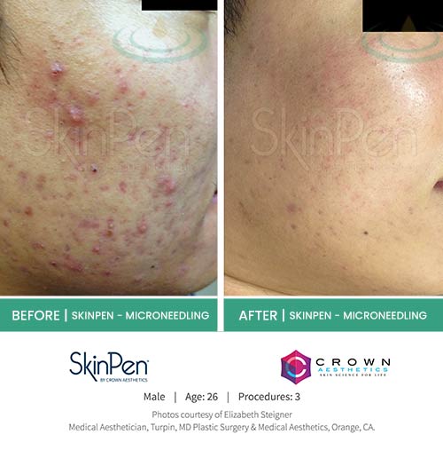 Before & After at Aspire Medical Aesthetics in Scarsdale & New York, NY Before & After at Aspire Medical Aesthetics in Scarsdale & New York, NY