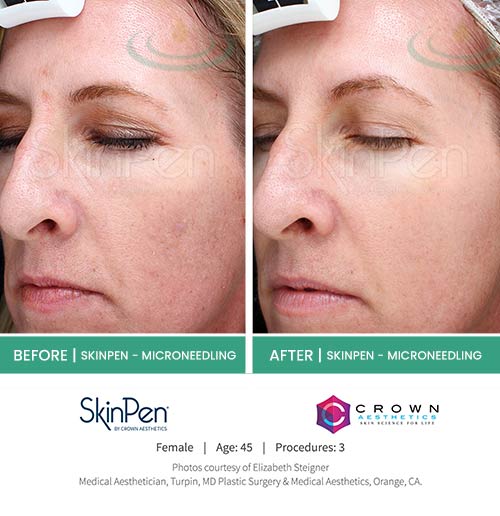 Before & After at Aspire Medical Aesthetics in Scarsdale & New York, NY Before & After at Aspire Medical Aesthetics in Scarsdale & New York, NY