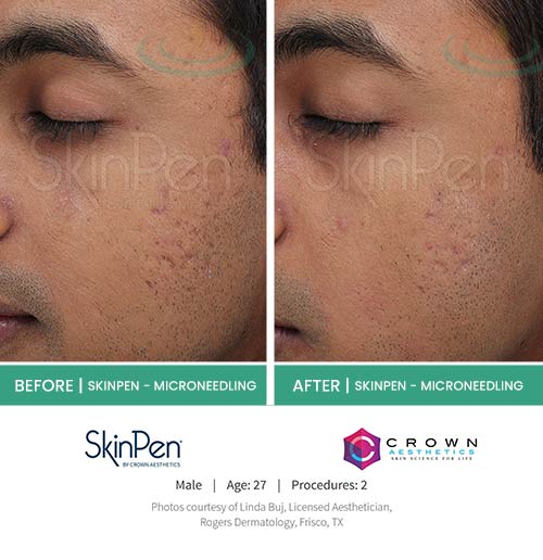 Before & After at Aspire Medical Aesthetics in Scarsdale & New York, NY Before & After at Aspire Medical Aesthetics in Scarsdale & New York, NY