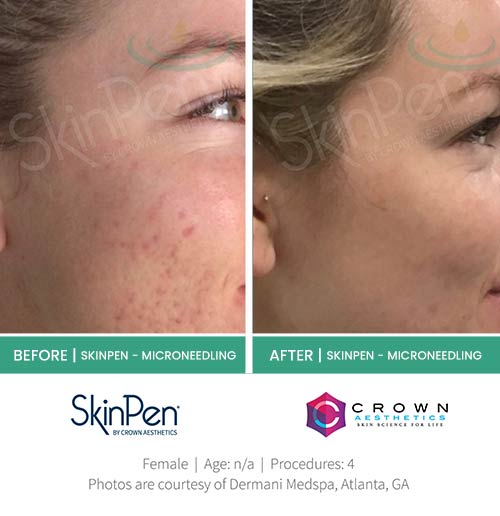 Before & After at Aspire Medical Aesthetics in Scarsdale & New York, NY Before & After at Aspire Medical Aesthetics in Scarsdale & New York, NY