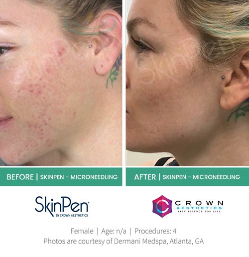 Before & After at Aspire Medical Aesthetics in Scarsdale & New York, NY Before & After at Aspire Medical Aesthetics in Scarsdale & New York, NY