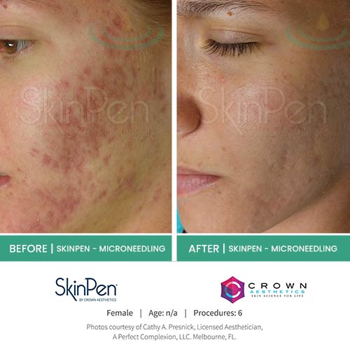 Before & After at Aspire Medical Aesthetics in Scarsdale & New York, NY Before & After at Aspire Medical Aesthetics in Scarsdale & New York, NY
