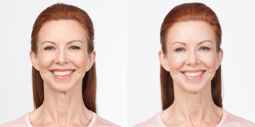 Before and After Image: Botox - front