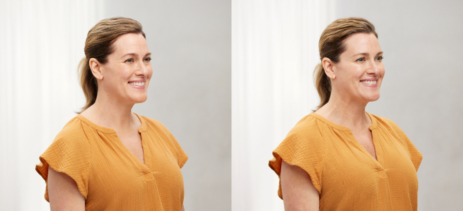 Before and After Image: Botox - right-front-oblique