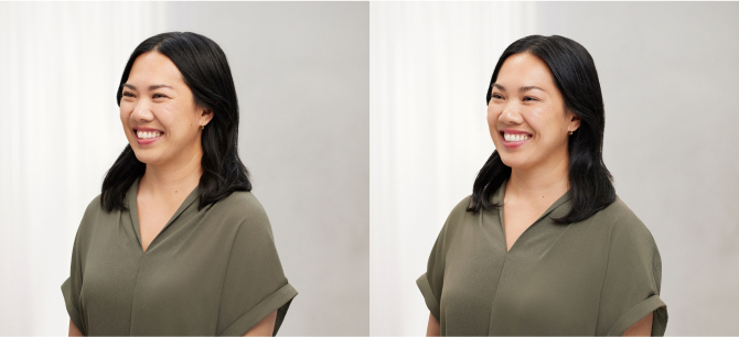 Before and After Image: Botox - left-front-oblique