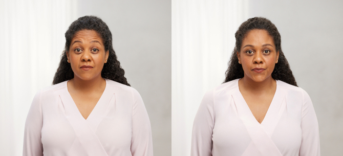 Before and After Image: Botox - front