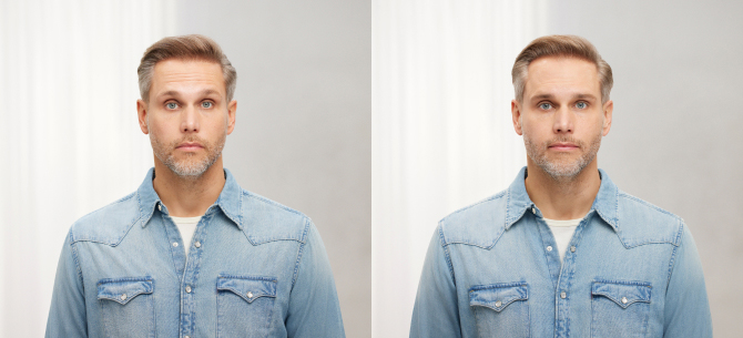 Before and After Image: Botox - front