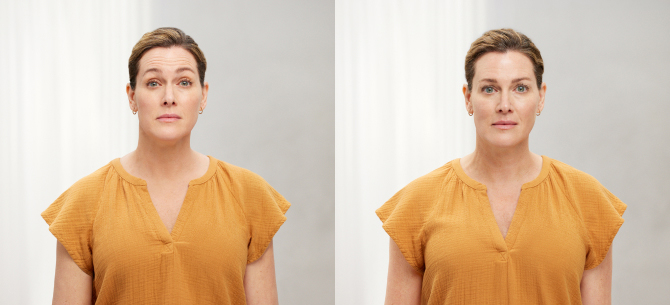 Before and After Image: Botox - front