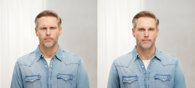 Before and After Image: Botox - front