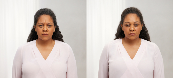 Before and After Image: Botox - front
