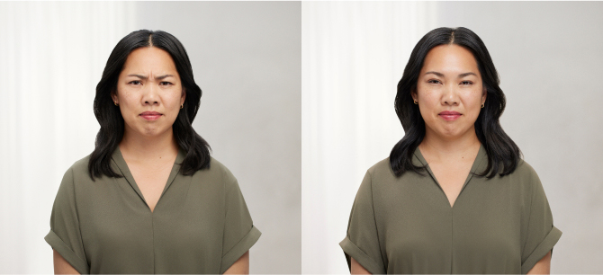 Before and After Image: Botox - front