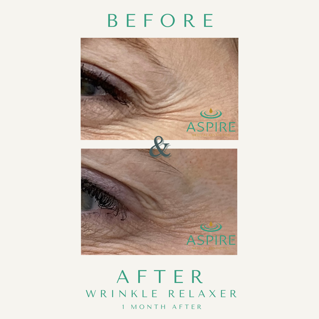 Before and After Image: Botox - left-front-oblique