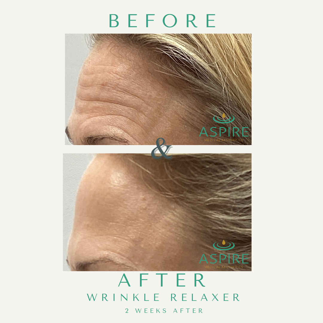 Before and After Image: Botox - left-front-oblique