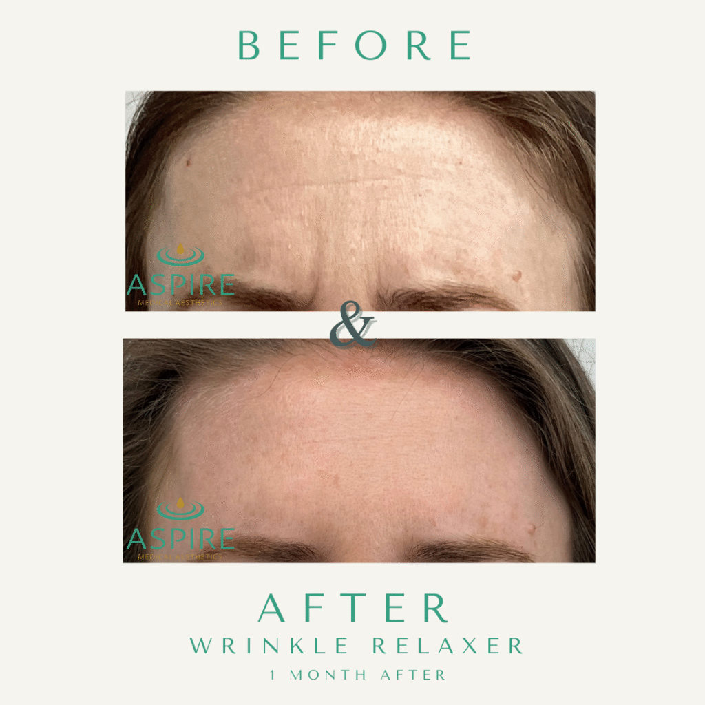 Before and After Image: Botox - front