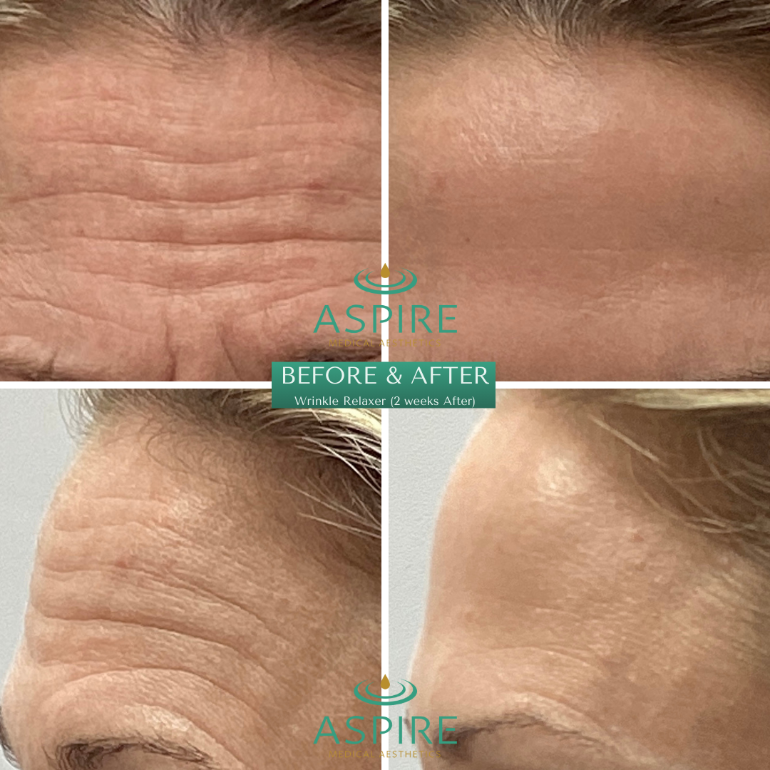 Before and After Image: Botox - front