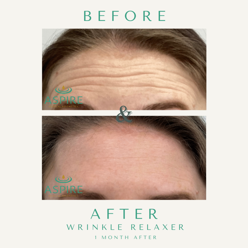 Before and After Image: Botox - front