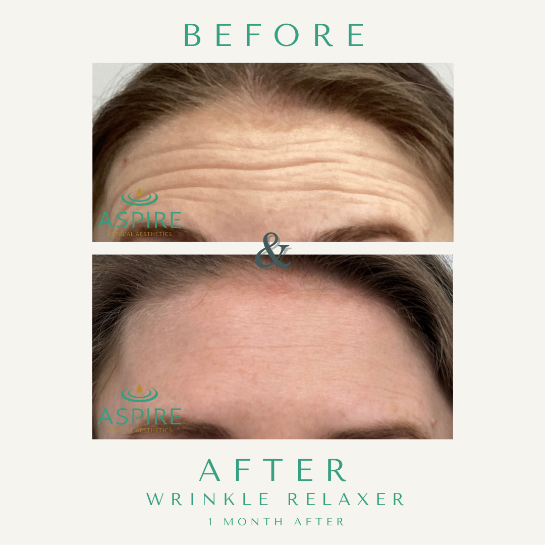 Before and After Image: Botox - front