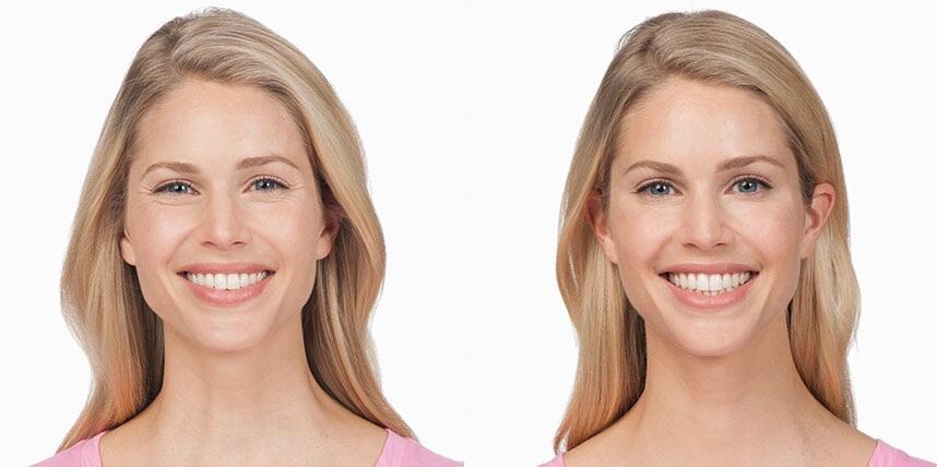 Before and After Image: Botox - front