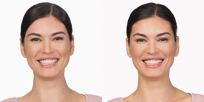 Before and After Image: Botox - front