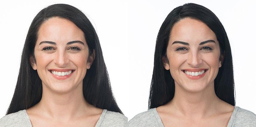 Before and After Image: Botox - front
