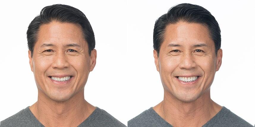 Before and After Image: Botox - front