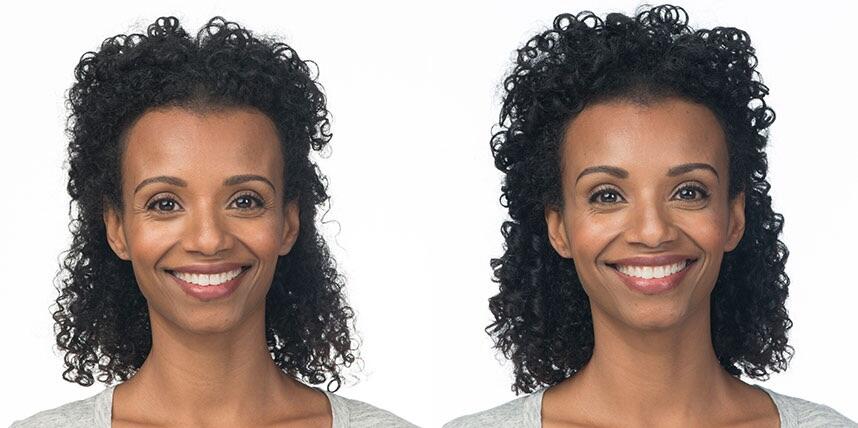 Before and After Image: Botox - front