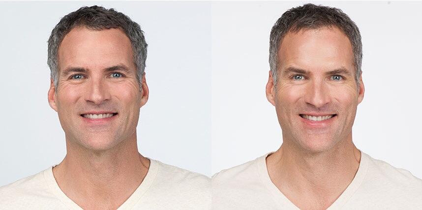 Before and After Image: Botox - front
