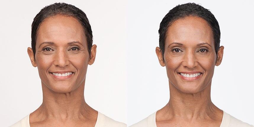 Before and After Image: Botox - front