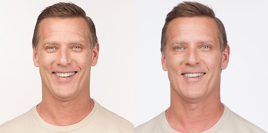 Before and After Image: Botox - front
