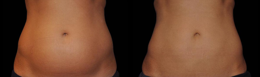 Before and After Image: CoolSculpting - front