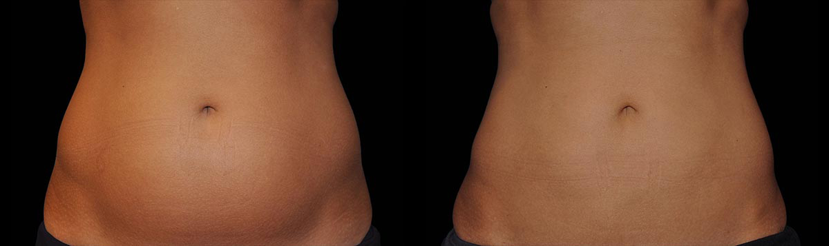 Before and After Image: CoolSculpting - front