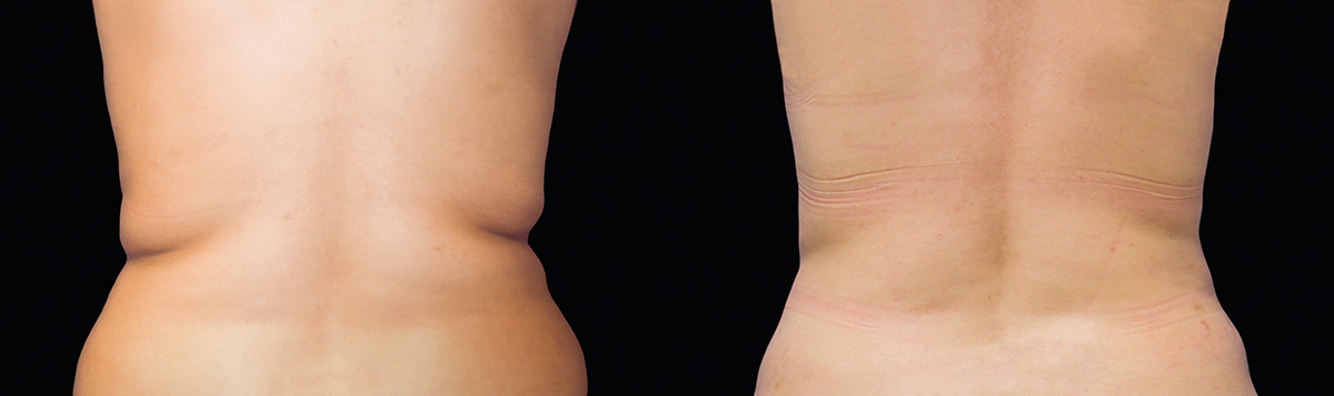 Before and After Image: CoolSculpting - back