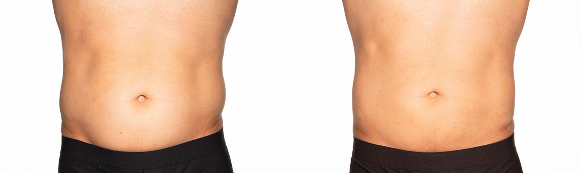 Before and After Image: CoolSculpting - front