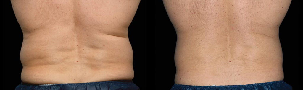 Before and After Image: CoolSculpting - back