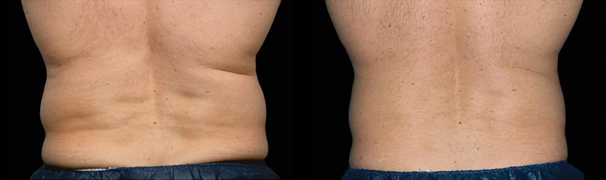 Before and After Image: CoolSculpting - back