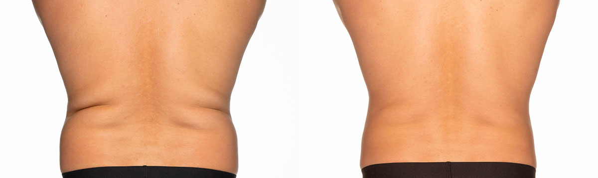 Before and After Image: CoolSculpting - back
