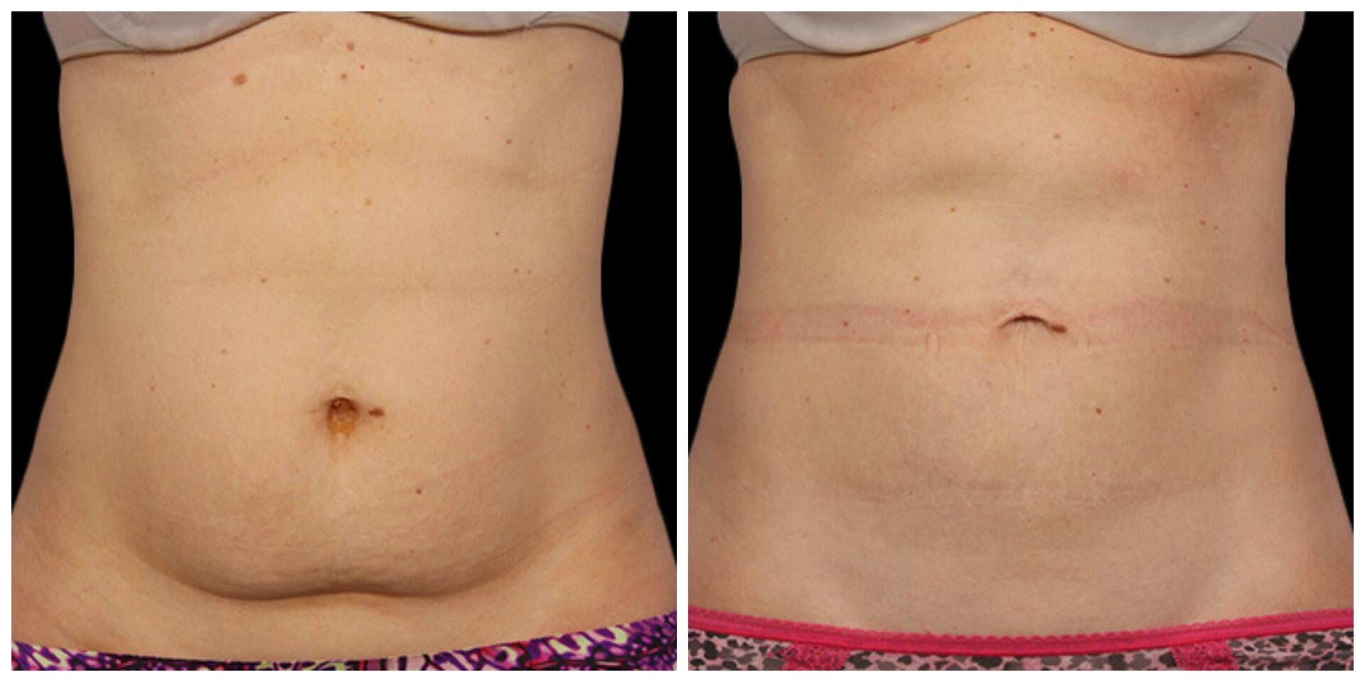 Before and After Image: CoolSculpting - front