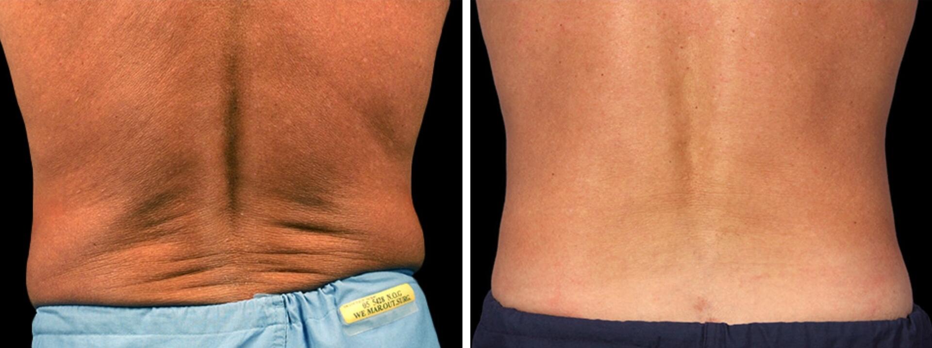 Before and After Image: CoolSculpting - back