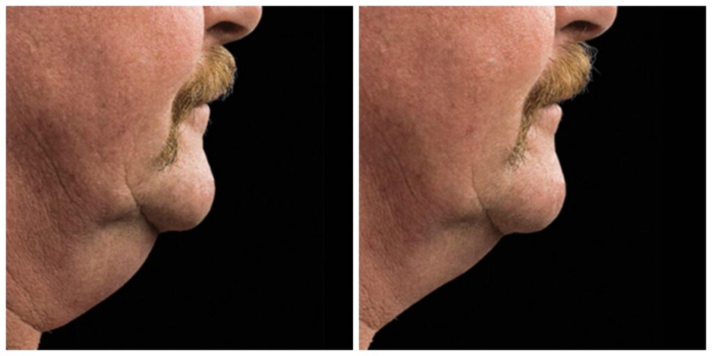 Before and After Image: CoolSculpting - right-side