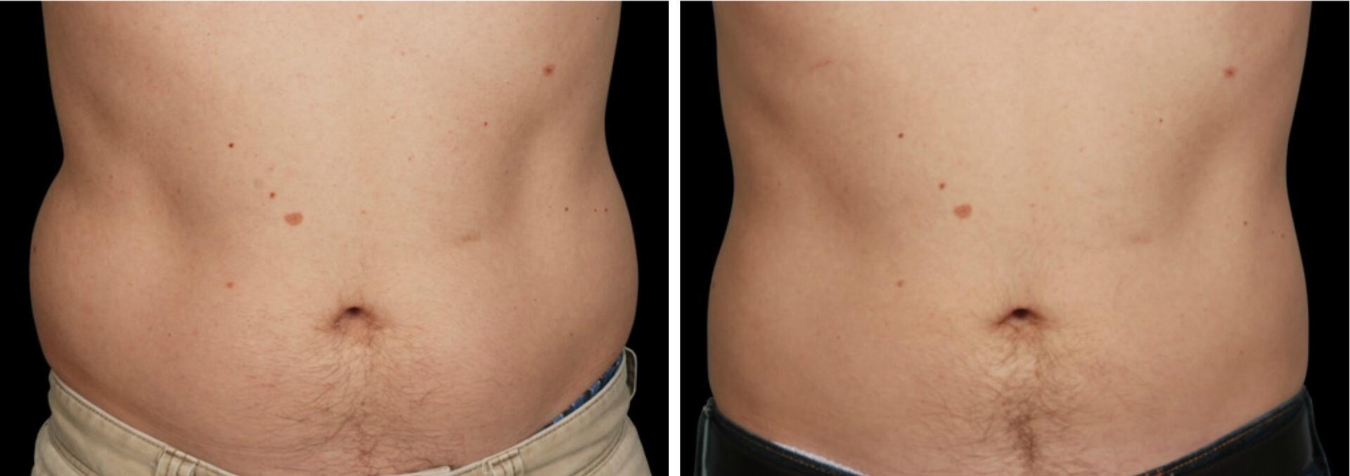 Before and After Image: CoolSculpting - front