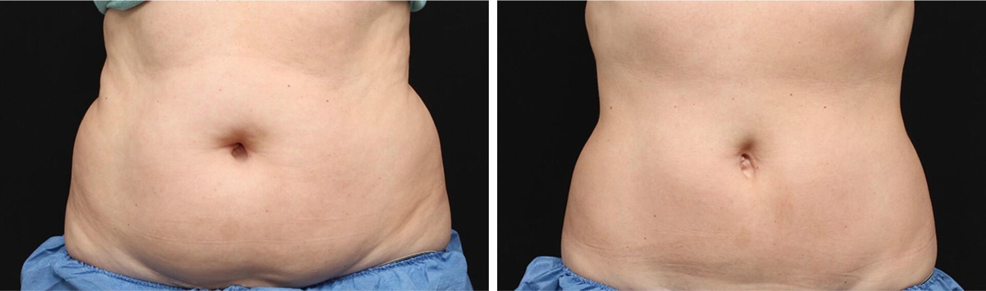 Before and After Image: CoolSculpting - front
