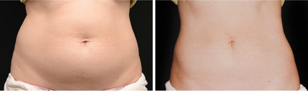 Before and After Image: CoolSculpting - front