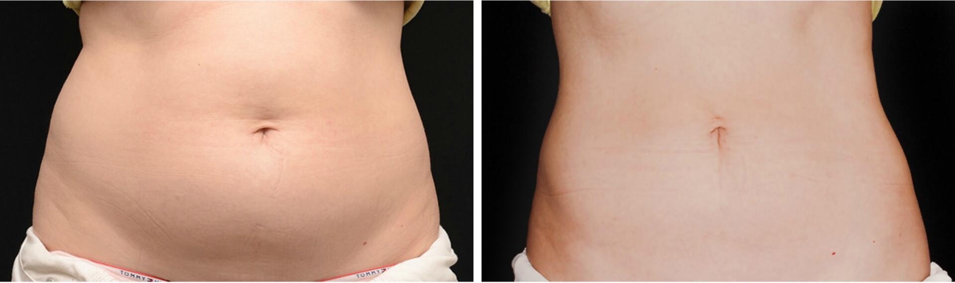 Before and After Image: CoolSculpting - front