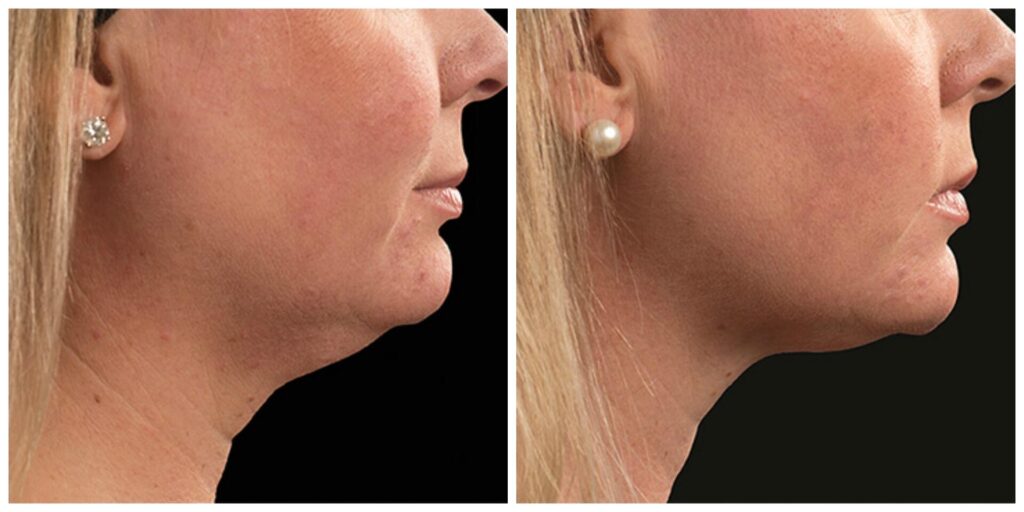 Before and After Image: CoolSculpting - right-side